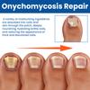 Parche Ximonth para el Cuidado de las Uñas, Uñas Suaves y Limpias para Manos y Pies, Cómodo, Fresco, Transpirable y Adecuado para el Cuidado