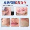 Pomada para Eczema para Aliviar a Coceira, Coceira na Pele de Adultos, Dermatite, Desumidificação, Infecção Fúngica, Escroto Úmido, Coceira na Área Anal