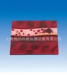 病态血管模型病理模型