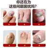 Crema Youdao para Uñas de Manos y Pies Cuidado de la Salud Líquido Extracto de Hierbas Douyin Kuaishou Transmisión en Vivo Comercio Electrónico Suministro Una Pieza Envío Directo