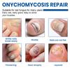Parche Ximonth para el Cuidado de las Uñas, Uñas Suaves y Limpias para Manos y Pies, Cómodo, Fresco, Transpirable y Adecuado para el Cuidado