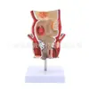 Modelo de lesión de hemorroides patología anorrectal modelo de hemorroides modelo de fisura anal interna y externa modelo médico de hemorroides