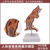 Modelo patológico de enfermedad esofágica humana enseñanza departamento digestivo hospital estómago respiratorio anatomía humana esofágico