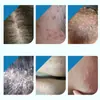 Inflamación del Folículo Piloso Tipo Cabeza Médico Antipirético Gel Oem Oem Musgo del Cuero Cabelludo Crema para Folículos Pilosos Acantosis Nigricans Personalización