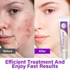 Esencia de Ácido Azelaico al 15%, Ungüento de Niacinamida al 12%, Gel Calmante para la Piel, Reduce Cicatrices de Acné y Manchas