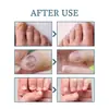 Ximonth Solución Reparadora de Uñas Uña Encarnada Engrosamiento Iluminación Uña Onicomicosis Uña Blanda Solución para el Cuidado de Uñas de Manos y Pies