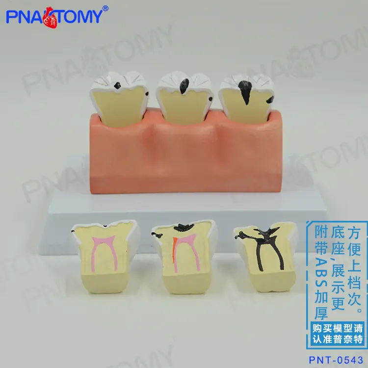 龋齿分解02