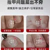 Producto más vendido: Pluma removedora de esmalte gris, Líquido reparador de uñas, Líquido para surcos de uñas, Líquido para levantar uñas, Líquido espesante para uñas, Tratamiento para uñas grises