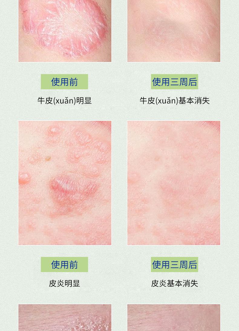 湿疹膏详情页_09