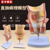 Modelo de Simulación de Enseñanza Patología Rectal Espécimen Intestinal Modelo Anatómico Humano Hemorroides Lesiones Anales Ayudas para la Enseñanza Médica