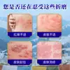 Ungüento Extractor de Anillo de Serpiente Zangyun 30g Anillo de Serpiente Anillo Erupción Ampolla Molestia Alivio Leve Ungüento Calmante