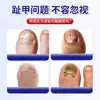 Parche Herbal de Medicina Tradicional China para Uñas Encarnadas, Parche de Uso Externo, Mismo Estilo que Douyin/Kuaishou, en Stock al por Mayor, Envío Directo de una Pieza