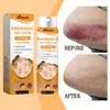 Ximonth Spray de Veneno de Abelha para Psoríase Tratamento para a Pele Spray para Cuidado da Vermelhidão