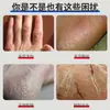 Crema para Congelación de Manos y Pies, Crema para Piel Agrietada, Crema Personalizada Anti-Grietas por Frío, Crema de Manos, Crema para Congelación, Apósito de Reparación de Piel OEM