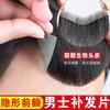 Substituição de linha capilar masculina com couro cabeludo biológico