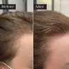 Set de Esencia con Microagujas para el Crecimiento y Engrosamiento del Cabello Más Vendido Transfronterizo Infusión con Microneedle