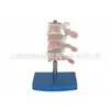 Modelo de Lesão Típica da Coluna Vertebral Modelo Médico