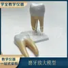 Modelo de ampliación de muela caries dental estructura dental odontología oral doctor-paciente comunicación caninos incisivos