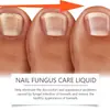 Set de Cuidado de Uñas de Manos y Pies Ximonth Solución para el Cuidado de Uñas de los Pies