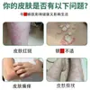 Rey de la Psoriasis Crema de Alta Eficiencia para la Psoriasis Venta al por Mayor Cabeza y Cuello Plateado Anticaspa Fórmula Japonesa Crema Antibacteriana para la Piel Anti-Picazón