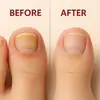 Exportación Transfronteriza Gotas para Hongos en Uñas de los Pies para Mejorar el Engrosamiento de las Uñas de Manos y Pies, Aclarar Onicomicosis y Solución para el Cuidado de los Pies