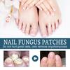 Ximonth Solución para el Cuidado de las Uñas Inserción de Uñas Engrosamiento Iluminador Onicomicosis Uña Blanda Solución para el Cuidado de Uñas de Manos y Pies