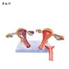 Modelo patológico uterino femenino estructura uterina ovárica materna y reproductiva Anatomía simulación avanzada modelo uterino mórbido