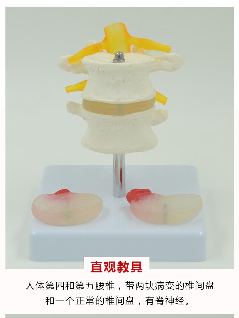 两节腰椎带椎间盘病变