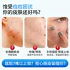 Parches para Acné con Forma de Estrella Médicos, Aislamiento UV, Impermeables, a Prueba de Polvo, Parches de Colores para Acné, Parches de Apósito de Hidrocoloide al por Mayor