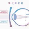 Bangeri Prevención y Control del Desenfoque en Jóvenes Lentes para Miopía Forma de Concha Asféricas 1.61 Lentes de Resina Luz Azul Anti-Azul