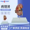 Estructura del Riñón Humano, Modelo de Anatomía de Órganos Internos por Enfermedad, Pelota Renal Urinaria, Enseñanza de Unidad Renal