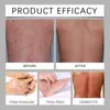 Ximonth Crema de Cuidado con Veneno de Abeja para Psoriasis Cuidado de la Piel Hidratación de la Piel Crema para el Cuidado de la Piel