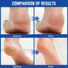 Tk Barra de Cuidado para Manos y Pies con Ácido Salicílico y Urea Transfronteriza para Otoño e Invierno para Prevenir la Sequedad y las Grietas, Hidratante e Hidratante