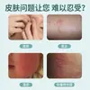 Pomada Médica para Cuidados com a Pele Teyixiyanping para Pele Sensível, Seca, Eritema, Coceira, Acne, Dermatite e Eczema