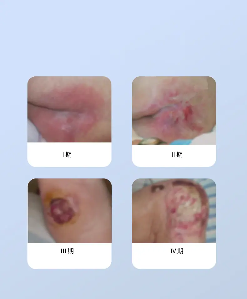 聚氨酯泡沫敷料_r3_c1