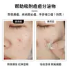 Parche hidrocoloide transparente para acné con aceite esencial listo para usar del fabricante, parche de maquillaje corrector invisible, succión de pus, parche para acné, impermeable y transpirable