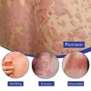Spray Calmante para la Piel South Moon Transfronterizo 30ml Alivia la Picazón de la Piel, Mejora la Descamación, la Picazón Seca y el Enrojecimiento