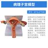Modelo anatómico patológico del útero reproductor femenino humano. Modelo didáctico del ovario vaginal. Material didáctico sobre reproducción ginecológica.