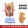 Modelo patológico del intestino grueso humano, modelo de anatomía gastrointestinal, modelo patológico del intestino grueso, ciego, recto y duodenal.