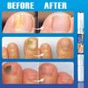 Lápiz reparador de uñas transfronterizo ERAYCEE, solución para el cuidado de las uñas con onicomicosis, limpieza y engrosamiento, lápiz reparador para onicomicosis.