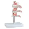 Modelo de Osteoporosis, Modelo de Lesión Típica de Columna Vertebral, Material de PVC, Modelo Anatómico de Esqueleto Humano