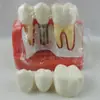 Produto de Comércio Exterior M2017R Modelo de Implante Dentário, Modelo de Implante Dentário com Coroa Destacável, Dente de Restauração de Prótese Removível