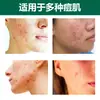 Lenços de Limpeza Shopee Mais Vendidos Cor Verde Estrelas Coloridas Pele com Acne para Clarear Acne e Espinhas Desenho Animado Formato Especial Pe Adesivo para Acne