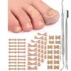 Adesivo de Unha Ortopédico Sulco da Unha Inlay na Unha Patch de Alongamento Ferramenta Ortopédica para Unha kit Adesivo para Unha de Manicure Reparo de Unha