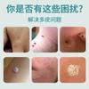 Teyi Gel Médico Antipirético para Eliminar Verrugas Crema para Eliminar Verrugas Cápsulas Diarias para Carnosidades Pequeñas y Eliminación de Manchas Planas Venta al por Mayor