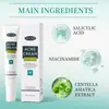 Crema para el Acné con Ácido Salicílico Transfronteriza Crema Facial para el Acné Desvanece Marcas de Acné, Crema para el Acné, Crema Control de Grasa, Inglés Completo