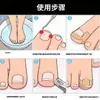 Parche ortopédico para corrección de uñas, estirador de uñas encarnadas, herramienta de corrección de surcos de uñas, juego de herramientas para enderezar uñas, parche de corrección de uñas en stock
