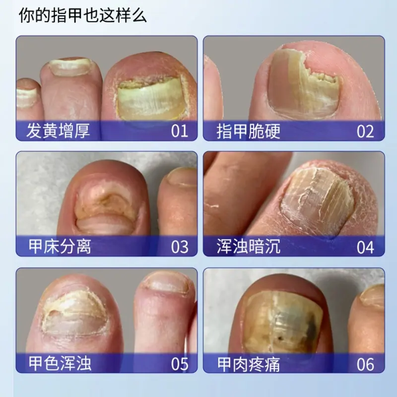 医用足部敷料-4