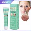 Creme de Tratamento para Acne Transfronteiriço Hbesty, Creme para Acne e Espinhas, Gel Facial de Controle de Oleosidade Anti-Acne