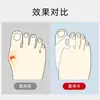 Corrector de silicona para juanete y valgo de dedo del pie, separador de dedos corrector, se puede usar con zapatos, adecuado para hombres y mujeres, para uso diurno y nocturno